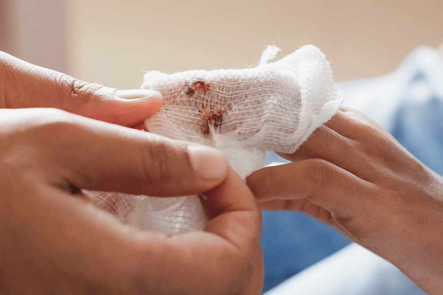 傷口化膿怎麼判斷? 簡單5步驟避免變成蜂窩性組織炎